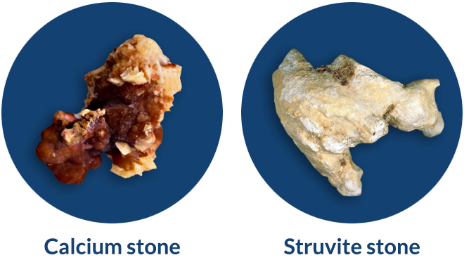 kidney_stones_types-01a