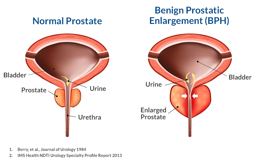 prostate-normal-enlarged-illustration