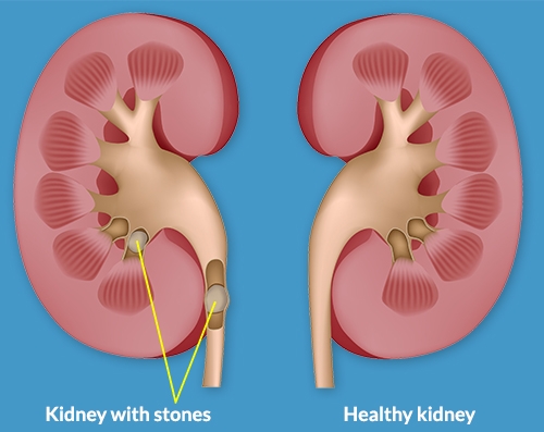 Kidney Stones Specialist Columbus Ohio | Signs of Kidney Stones